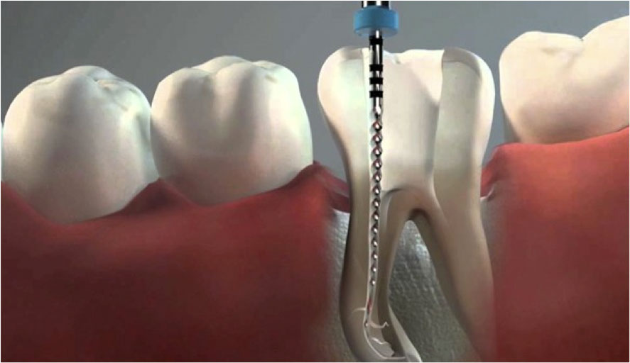 Endodoncia - Tratamiento radicular